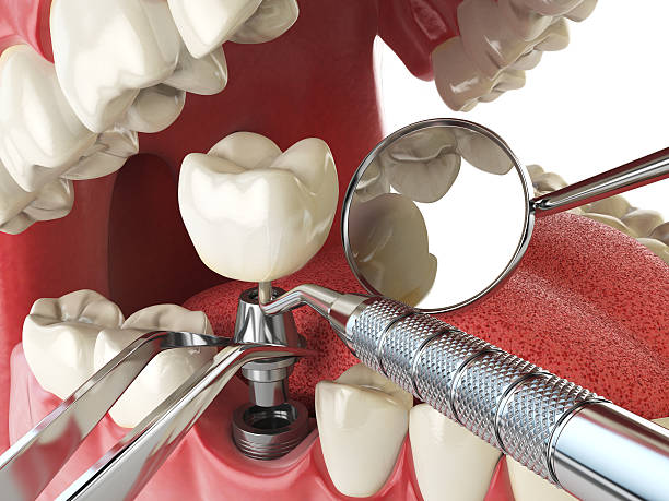 Best Emergency Root Canal Treatment in Mount Carroll, IL